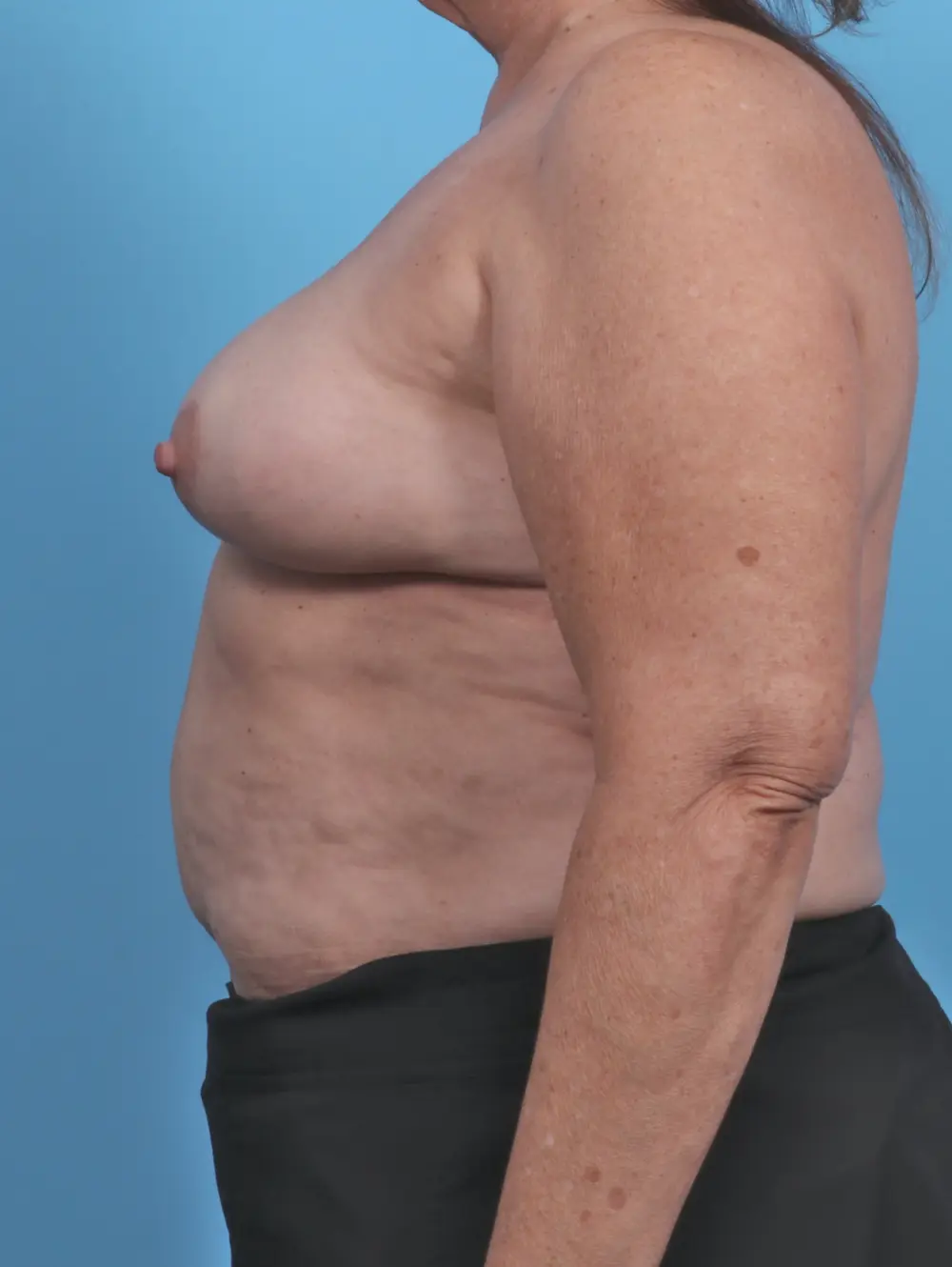 Breast Implant Removal Patient Photo - Case 44967 - after view-2