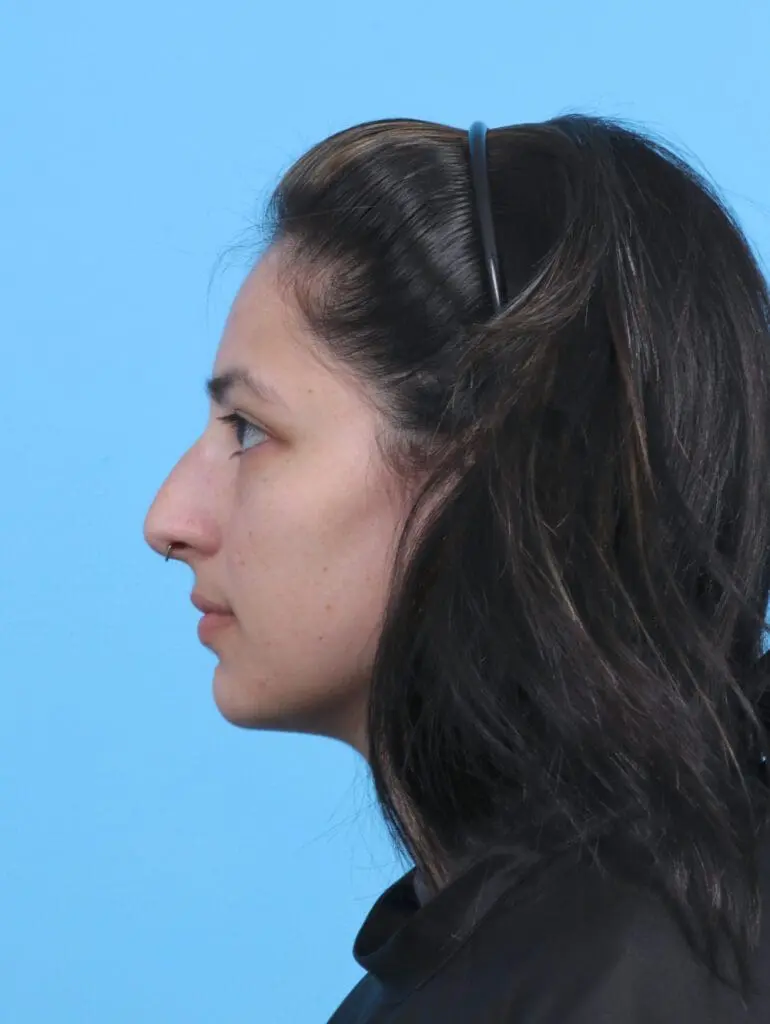 Rhinoplasty - Case 45220 - Before