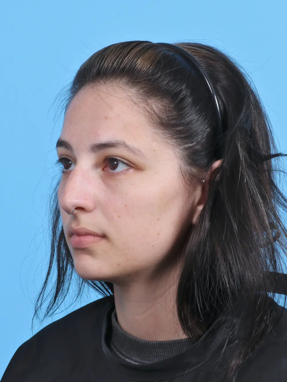 Rhinoplasty Patient Photo - Case 45220 - before view-1