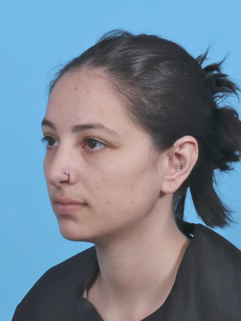 Rhinoplasty Patient Photo - Case 45220 - after view-1