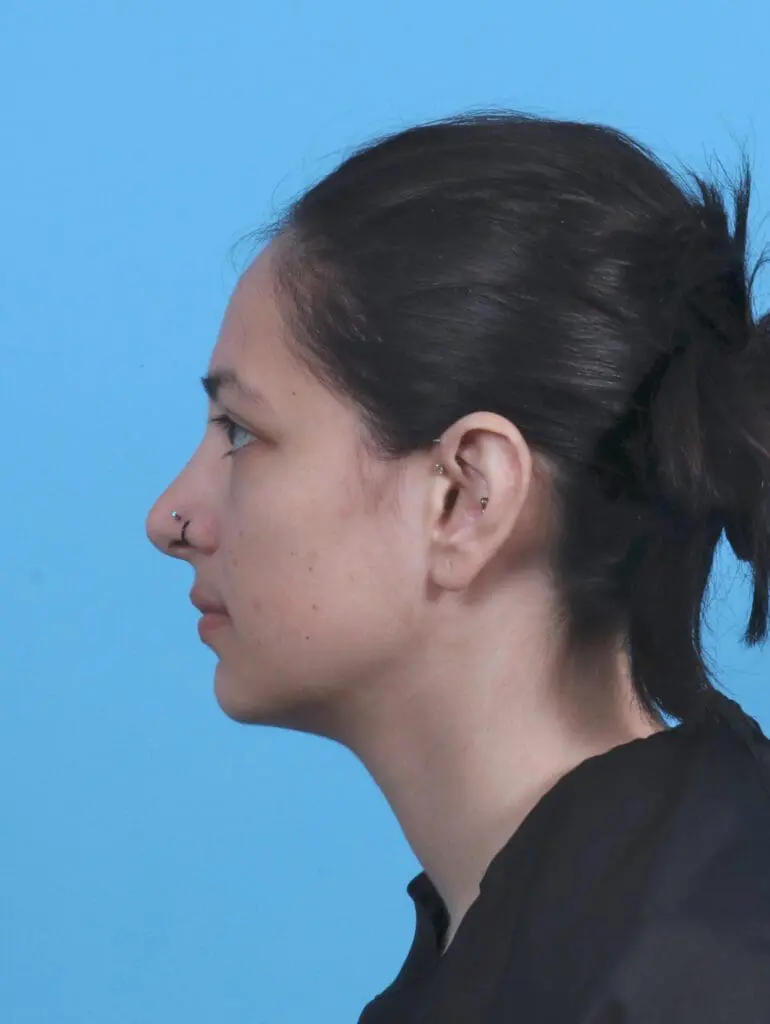 Rhinoplasty - Case 45220 - After