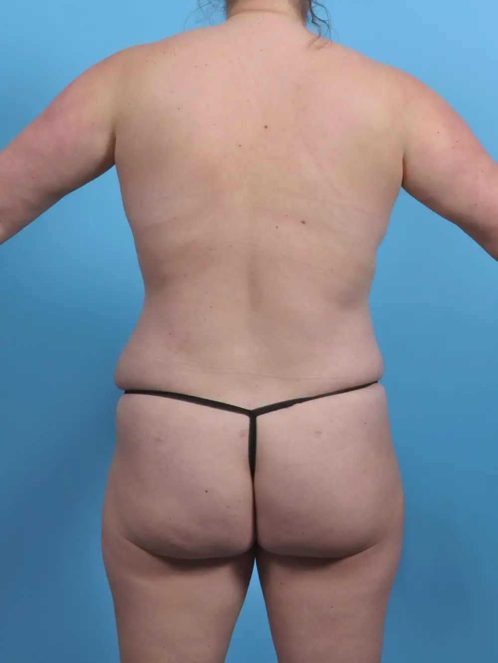 Breast Lift/Reduction with Implants Patient Photo - Case 45229 - after view-3