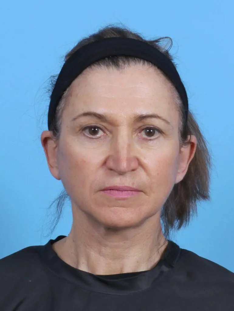 Facelift / Neck Lift - Case 45259 - After