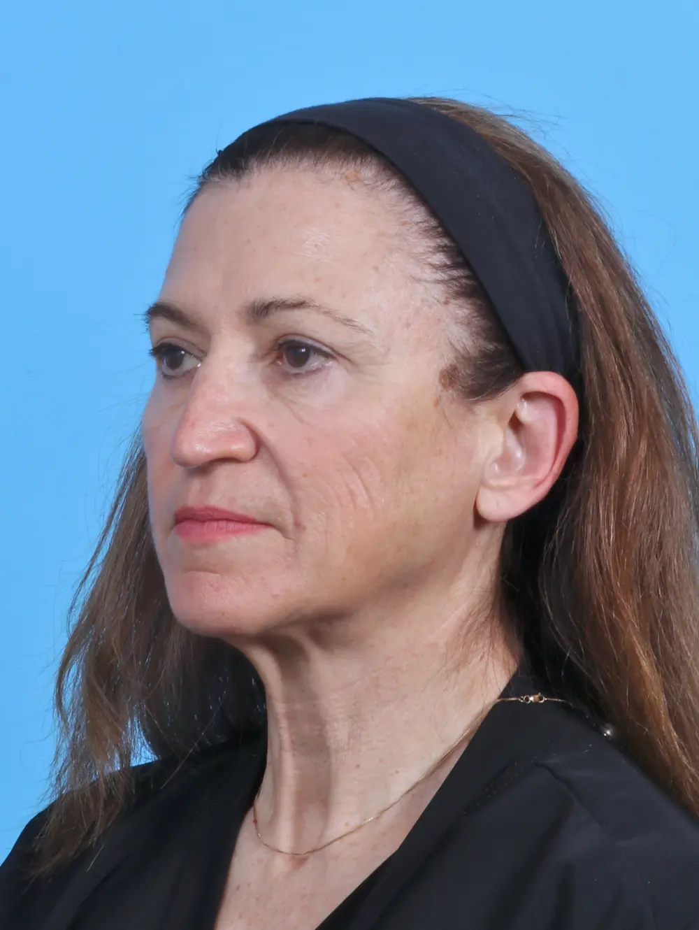 Facelift / Neck Lift Patient Photo - Case 45259 - before view-1