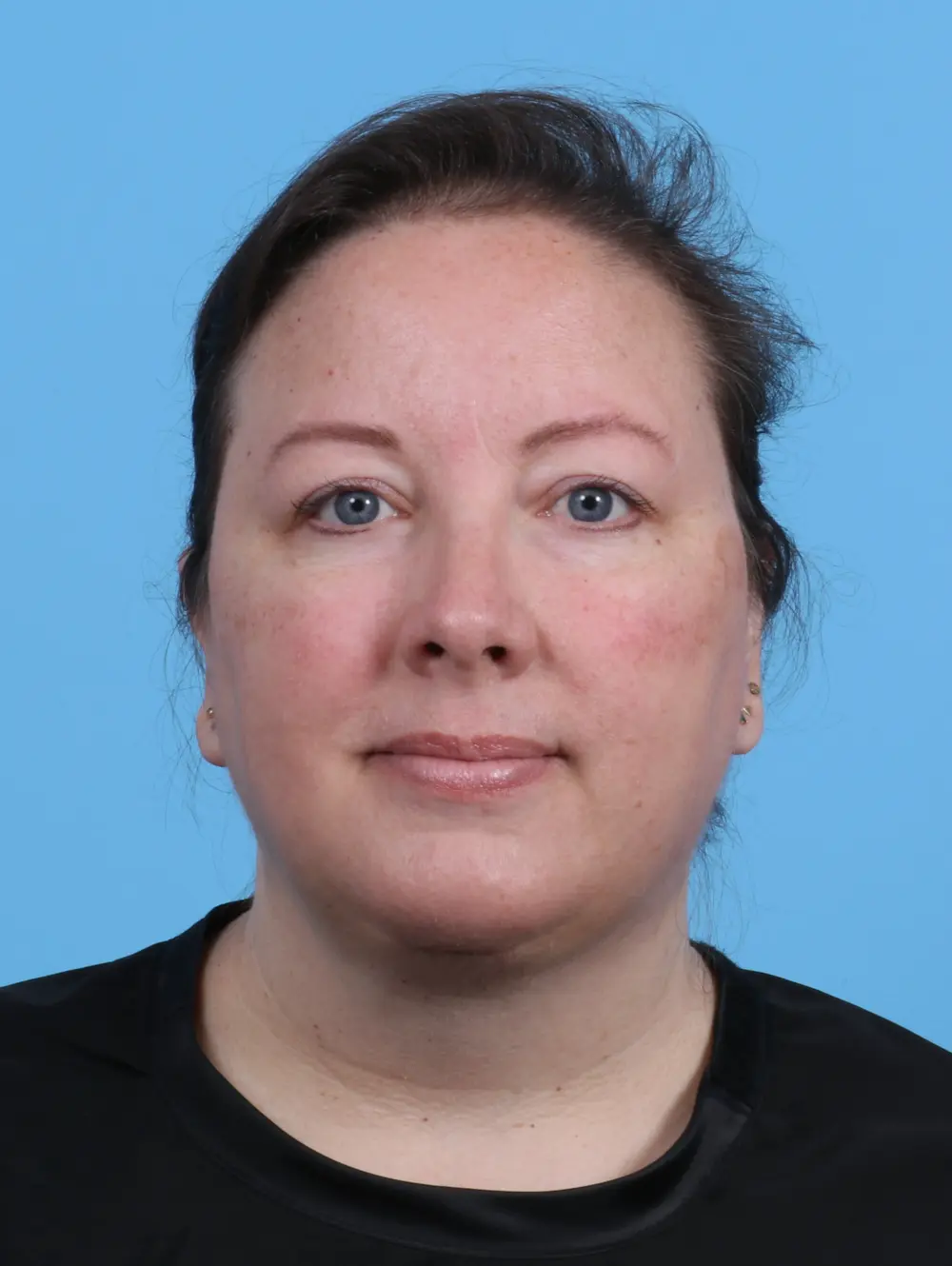 Anterior Neck Lift Patient Photo - Case 45269 - after view-2