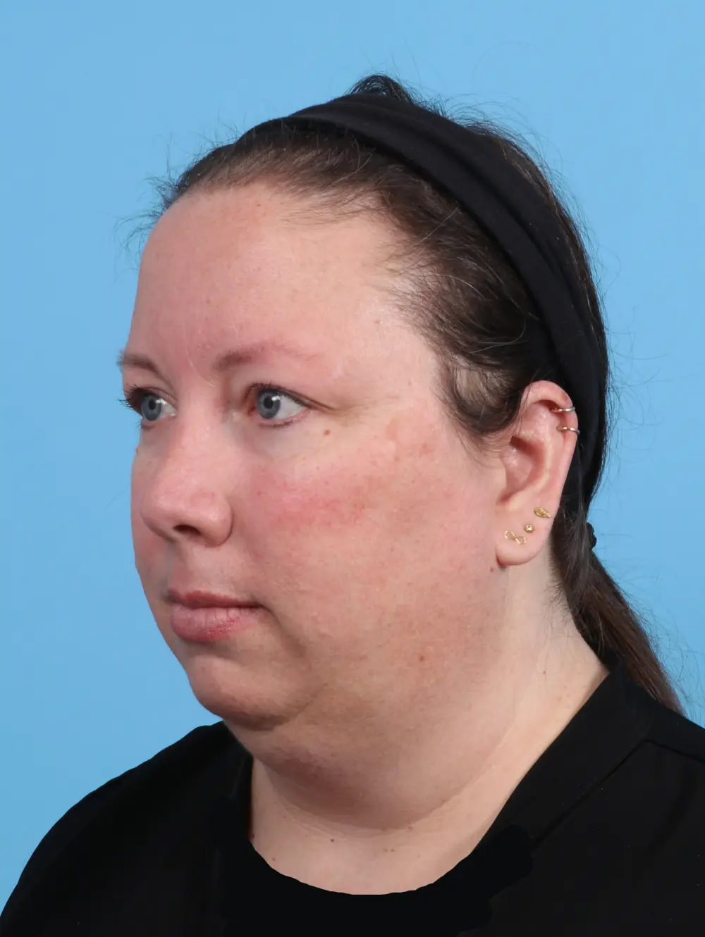 Anterior Neck Lift Patient Photo - Case 45269 - before view-1