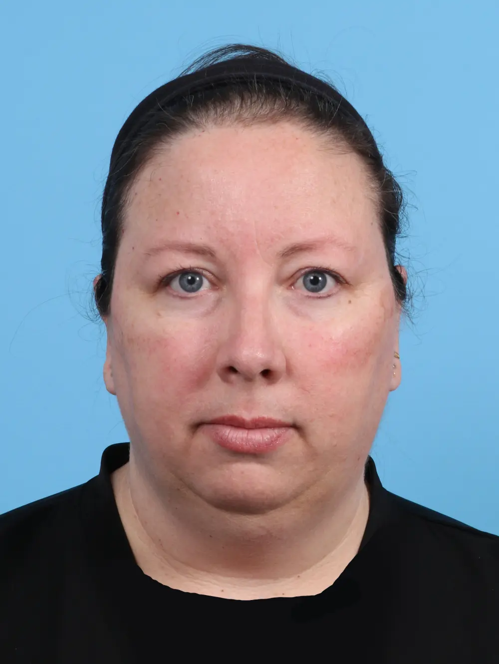 Anterior Neck Lift Patient Photo - Case 45269 - before view-2