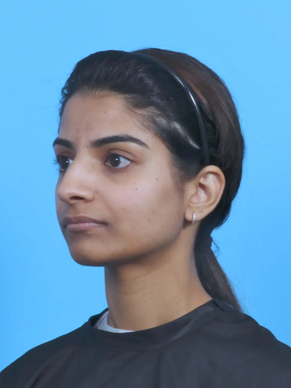Rhinoplasty Patient Photo - Case 45303 - before view-1