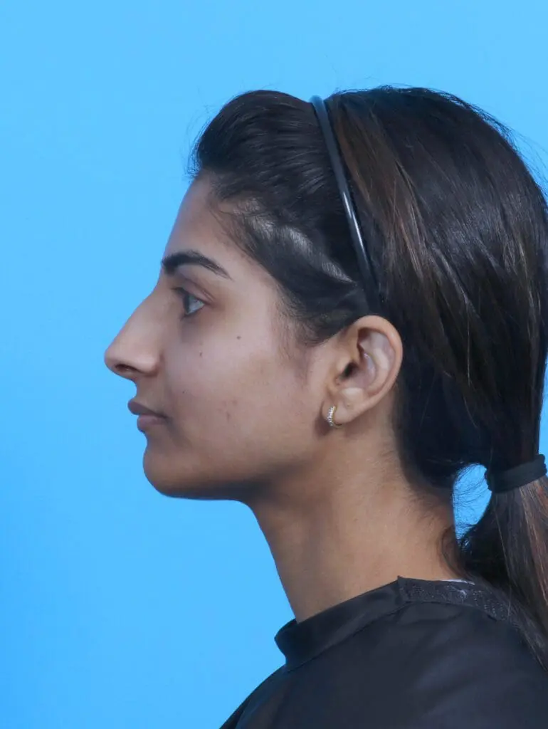 Rhinoplasty - Case 45303 - Before