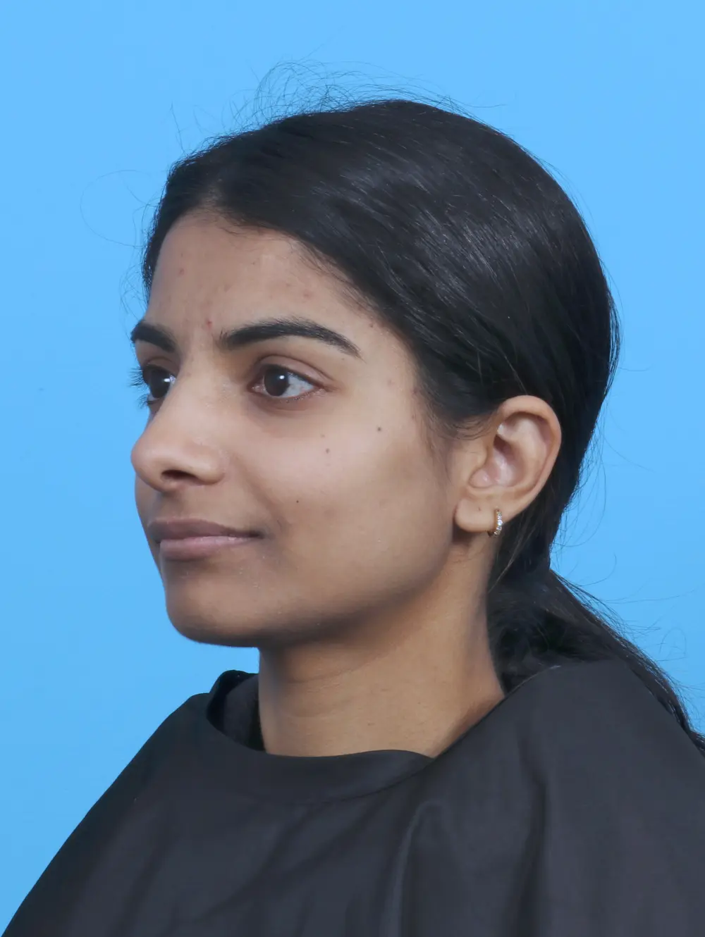 Rhinoplasty Patient Photo - Case 45303 - after view-1