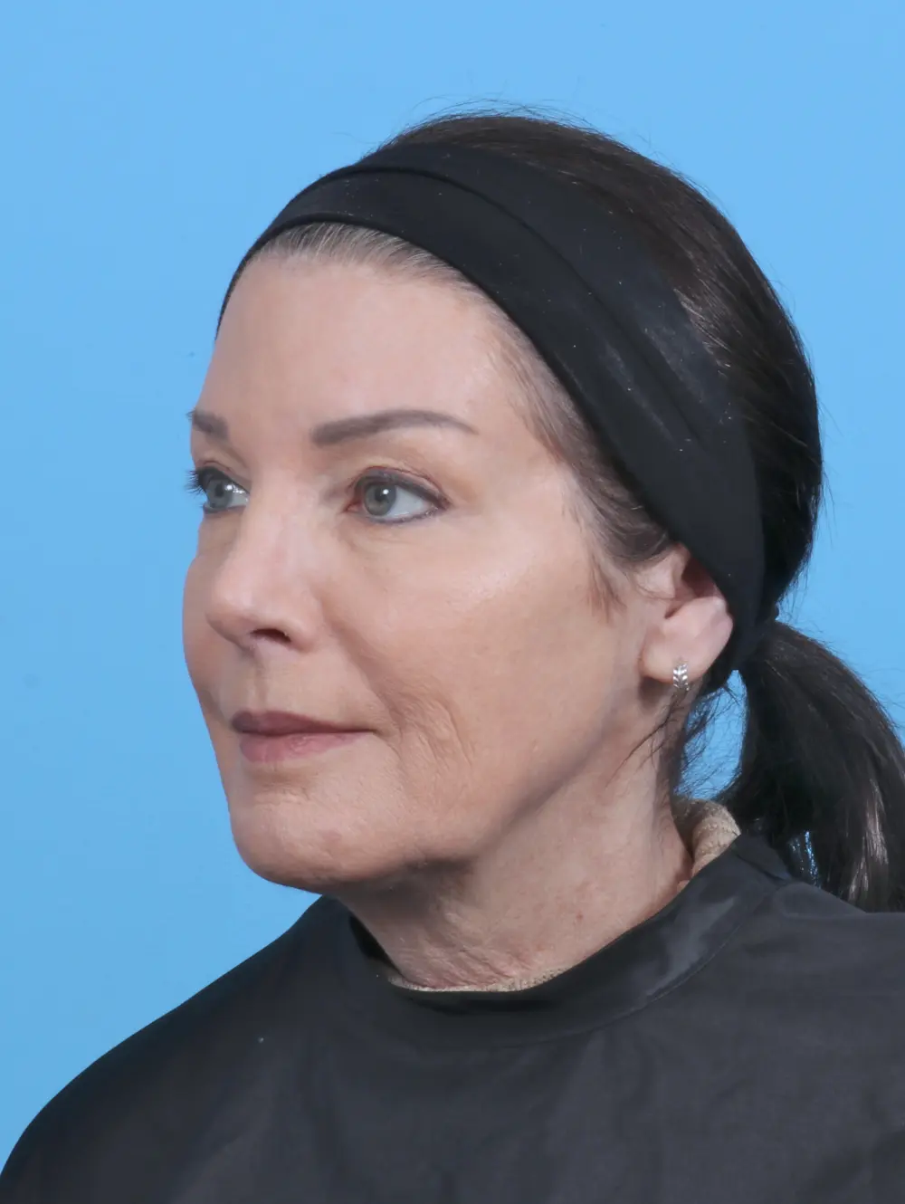 Rhinoplasty Patient Photo - Case 45311 - after view-1