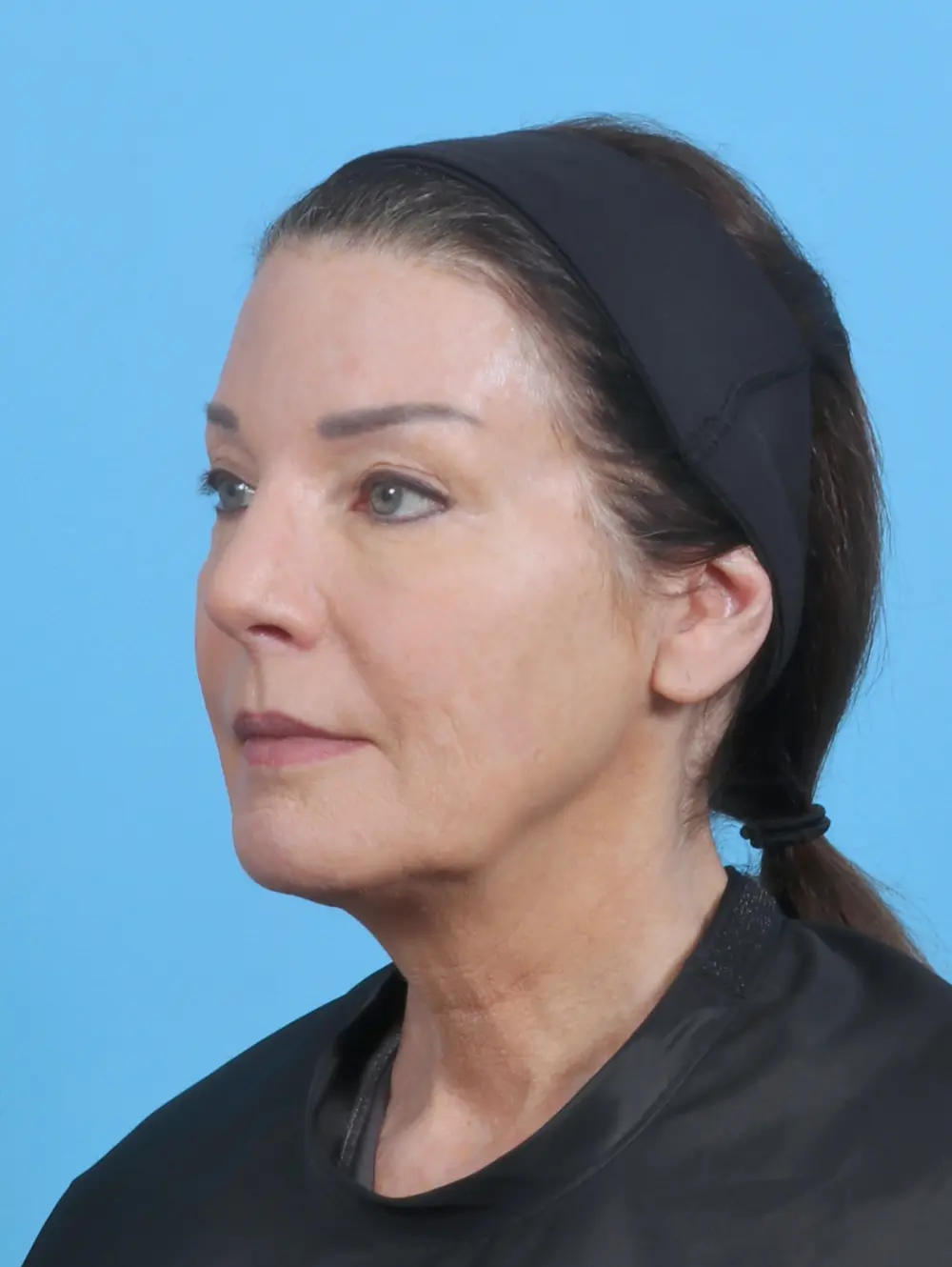 Rhinoplasty Patient Photo - Case 45311 - before view-1