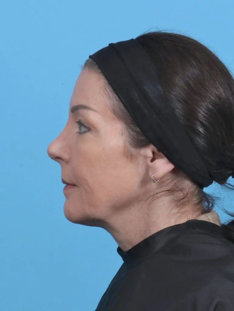 Rhinoplasty - Case 45311 - After