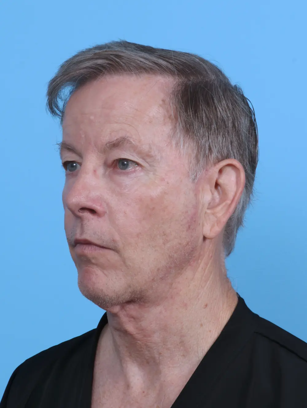 Eyelid Surgery Patient Photo - Case 45452 - before view-1