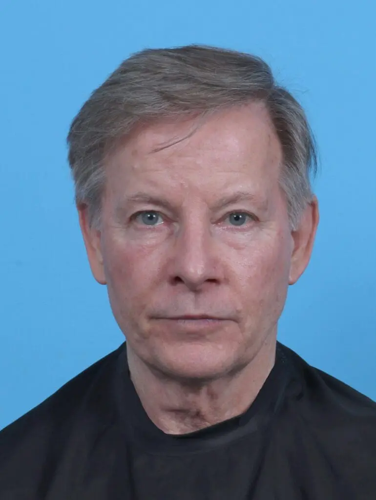 Eyelid Surgery - Case 45452 - After