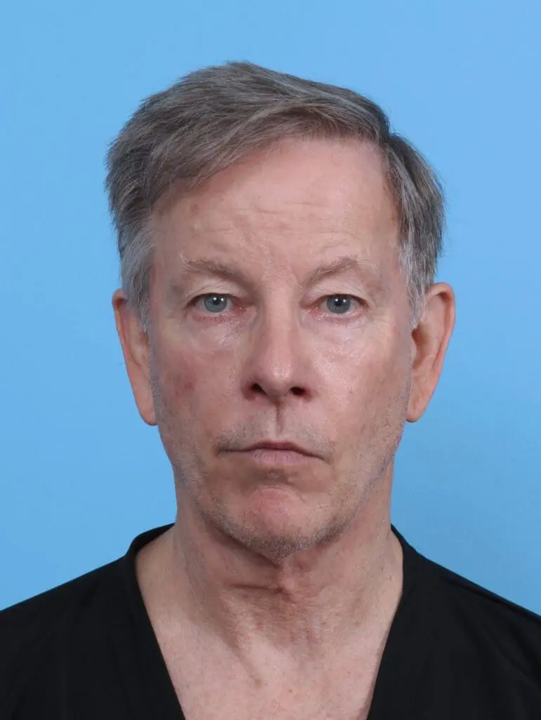 Eyelid Surgery - Case 45452 - Before