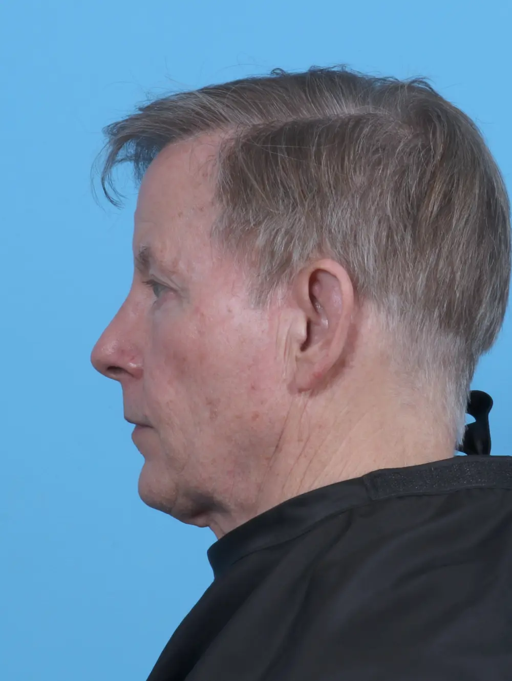 Eyelid Surgery Patient Photo - Case 45452 - after view-2