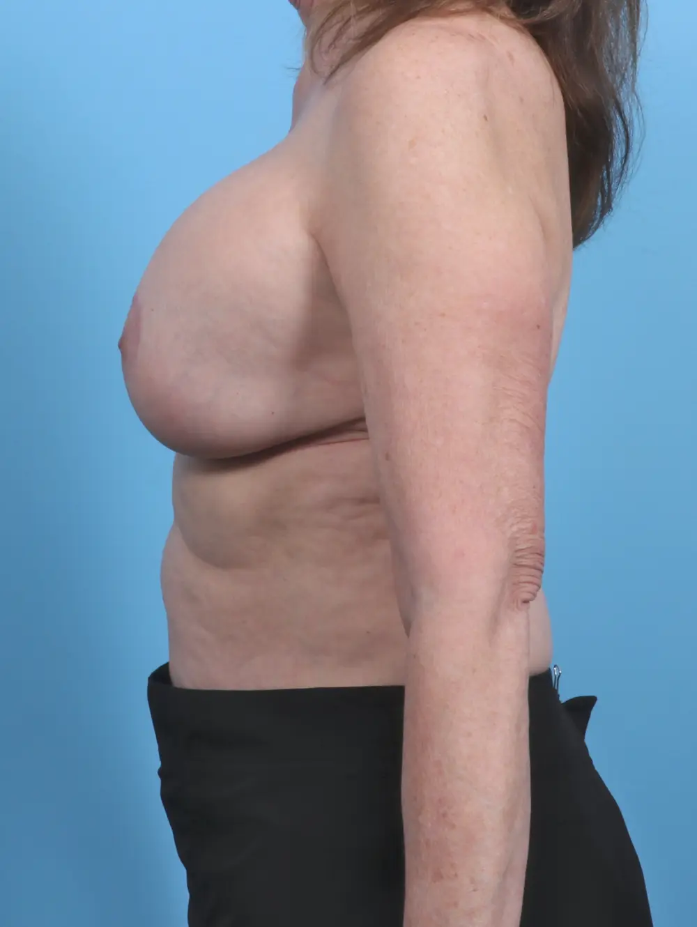 Breast Implant Revision Patient Photo - Case 45568 - before view-2