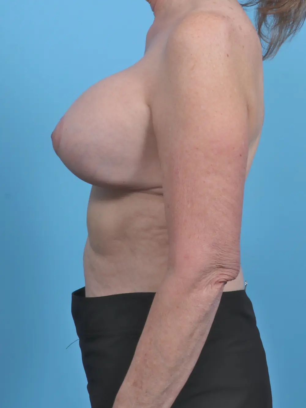 Breast Implant Revision Patient Photo - Case 45568 - after view-2