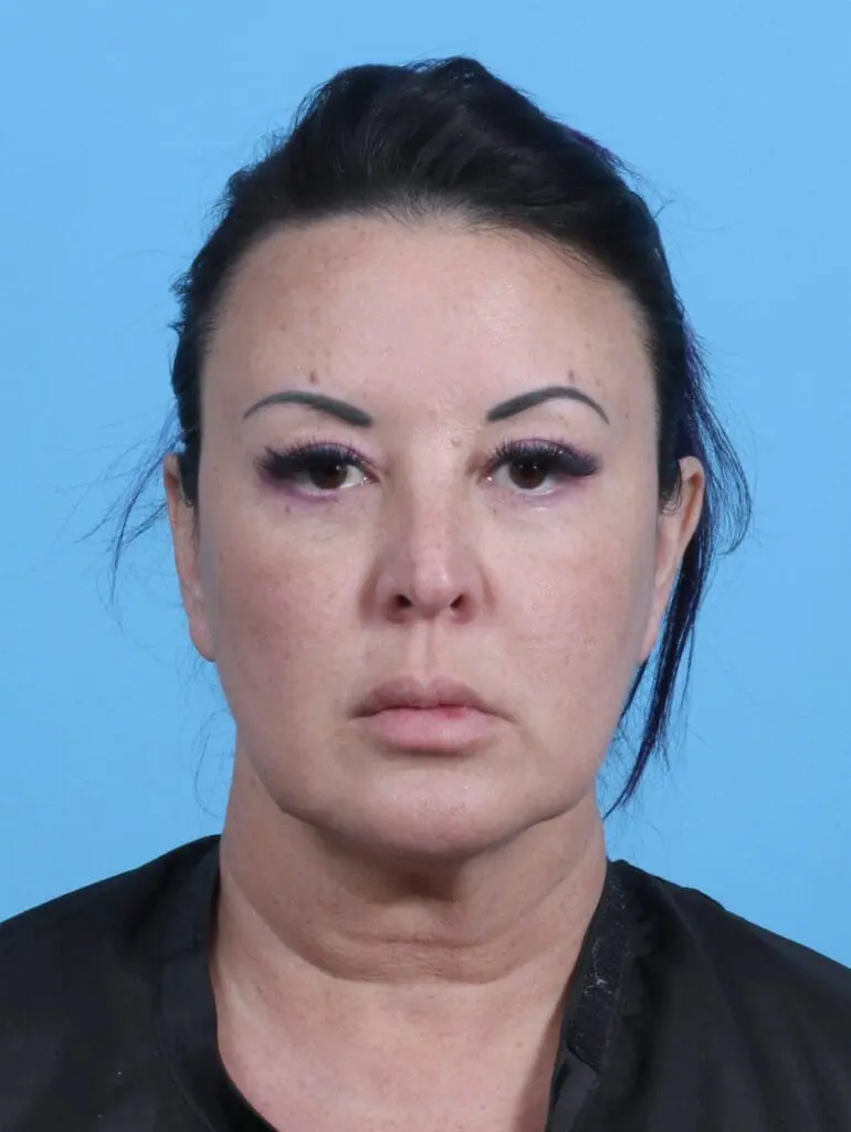 Facelift / Neck Lift - Case 45585 - Before