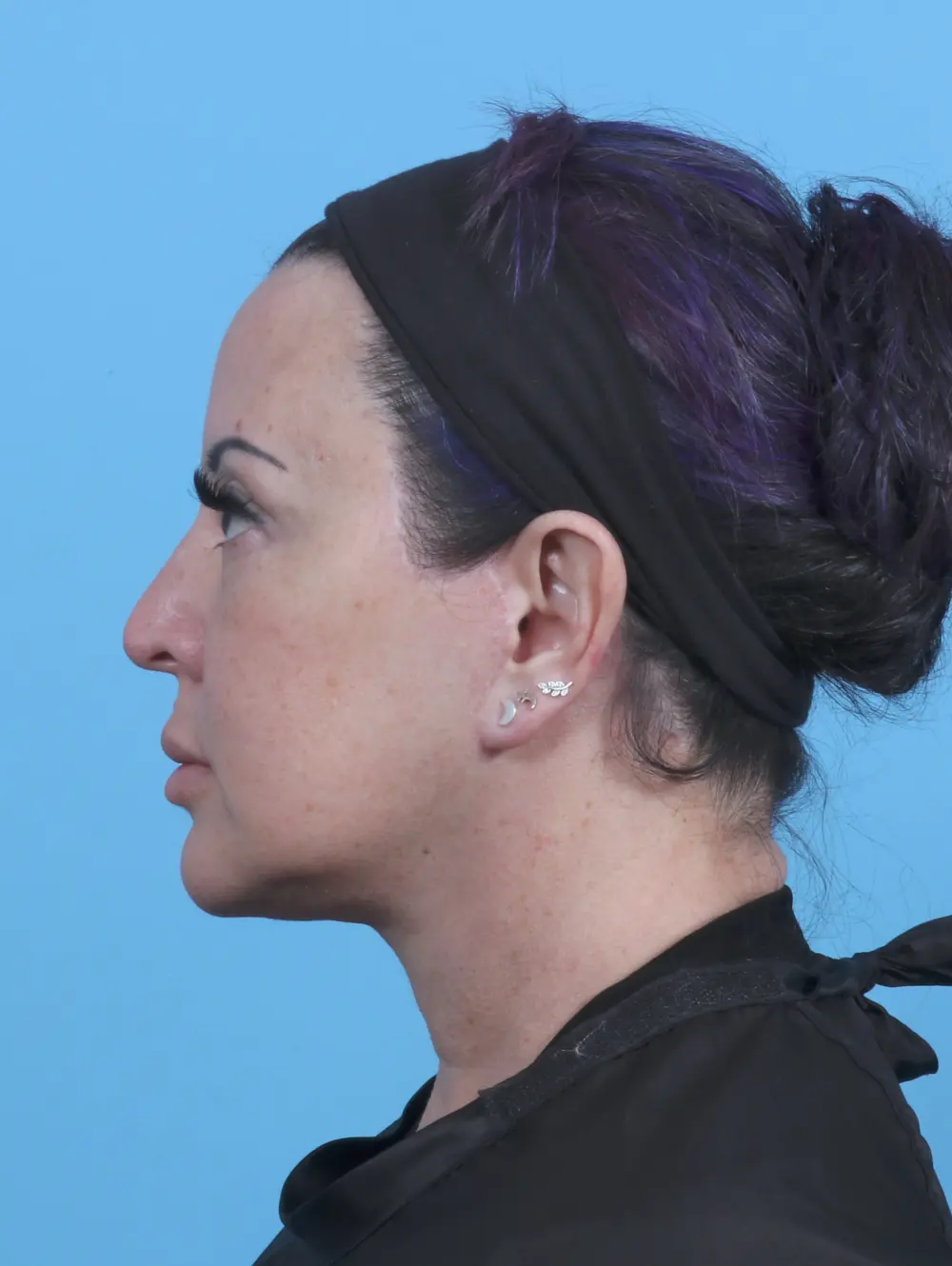 Facelift / Neck Lift Patient Photo - Case 45585 - after view-2