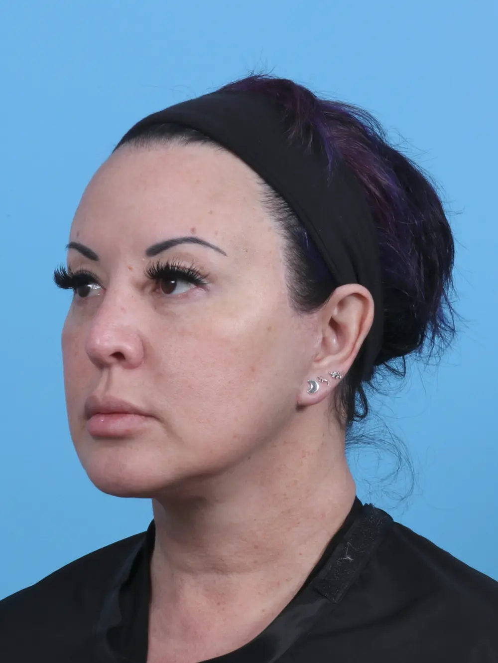 Facelift / Neck Lift Patient Photo - Case 45585 - after view-1
