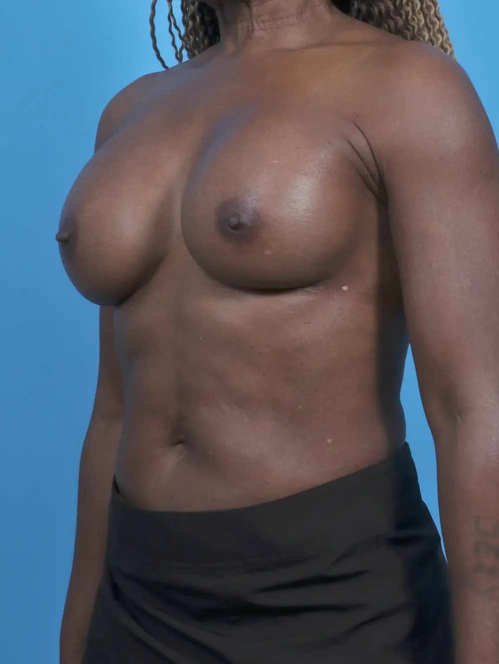 Breast Augmentation Patient Photo - Case 45610 - after view-1