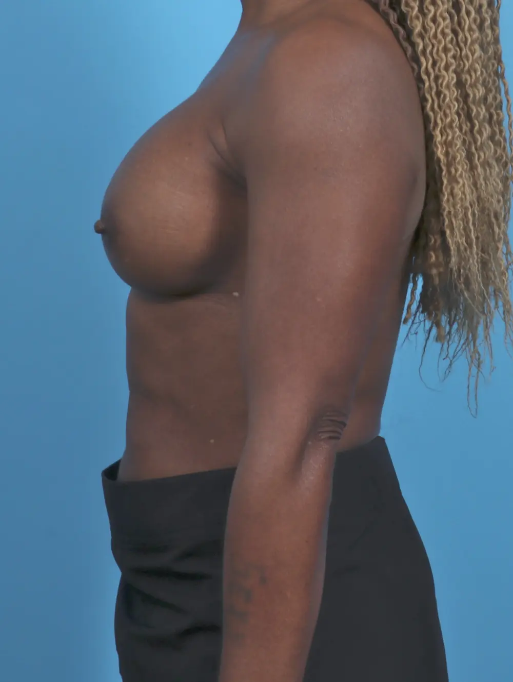 Breast Augmentation Patient Photo - Case 45610 - after view-2