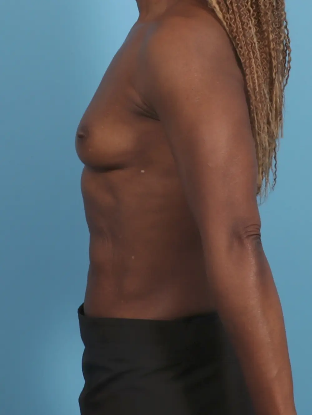 Breast Augmentation Patient Photo - Case 45610 - before view-2