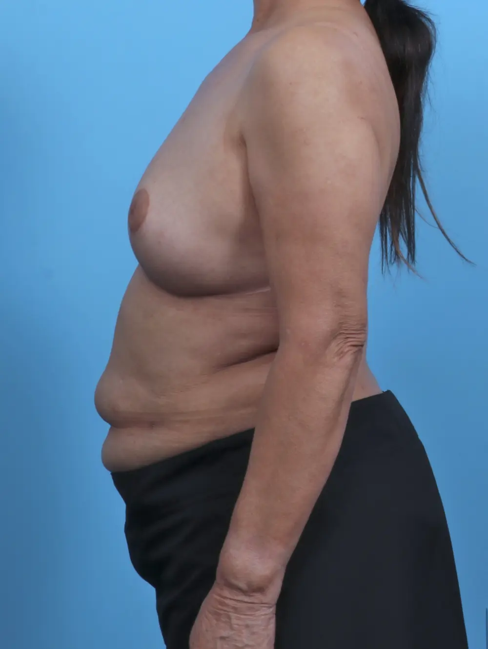 Breast Lift/Reduction w/o Implants Patient Photo - Case 45669 - after view-2