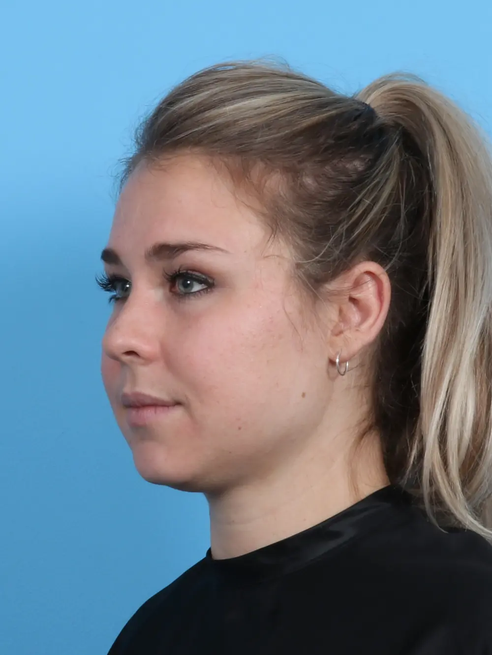 Buccal Fat Removal Patient Photo - Case 45771 - before view-1