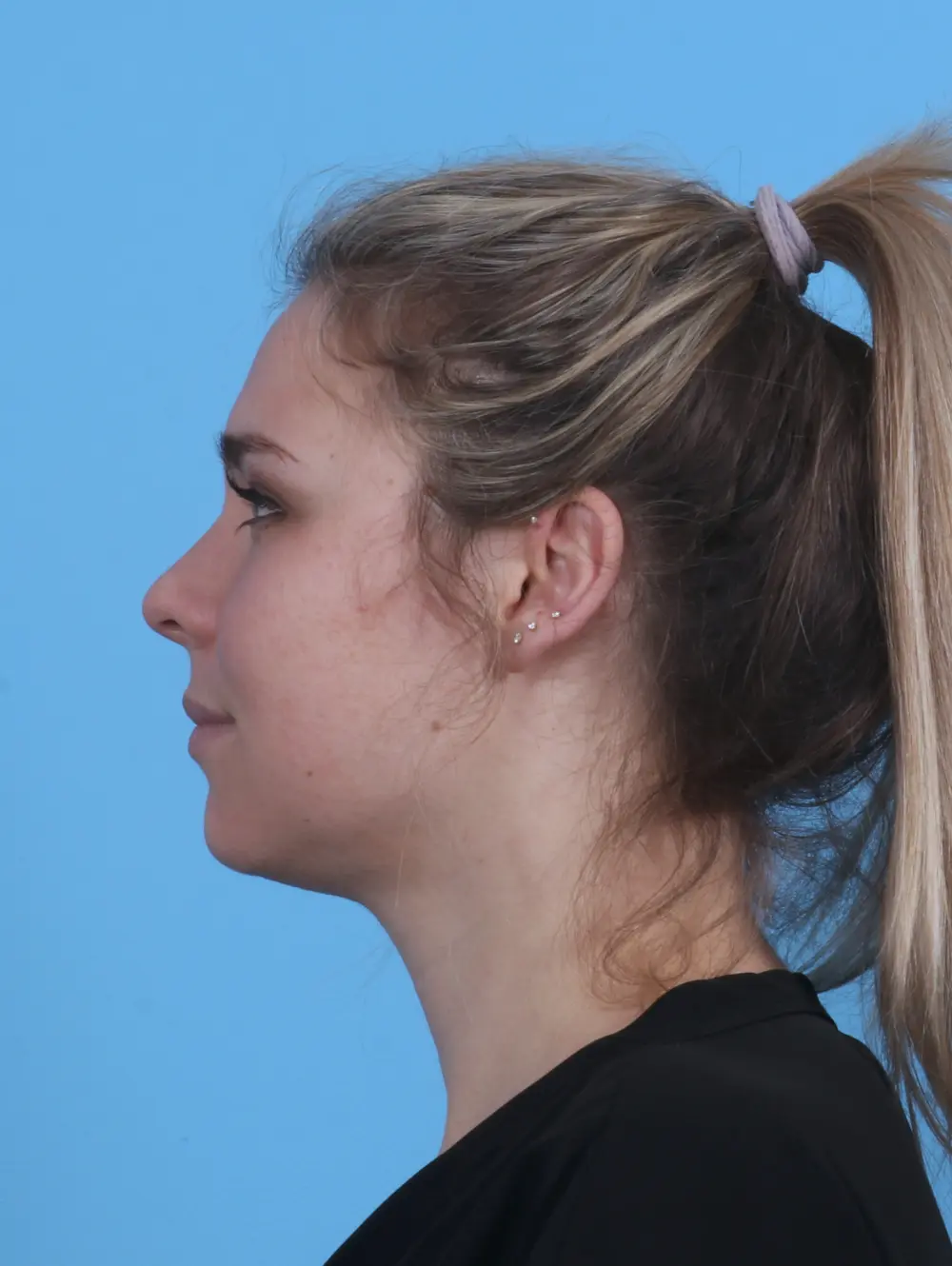 Buccal Fat Removal Patient Photo - Case 45771 - after view-2