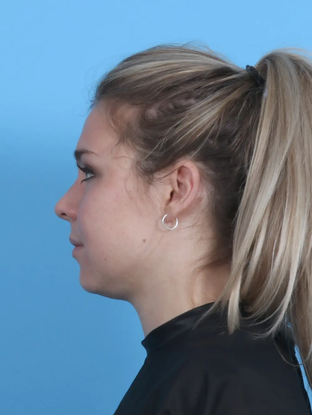 Buccal Fat Removal Patient Photo - Case 45771 - before view-2