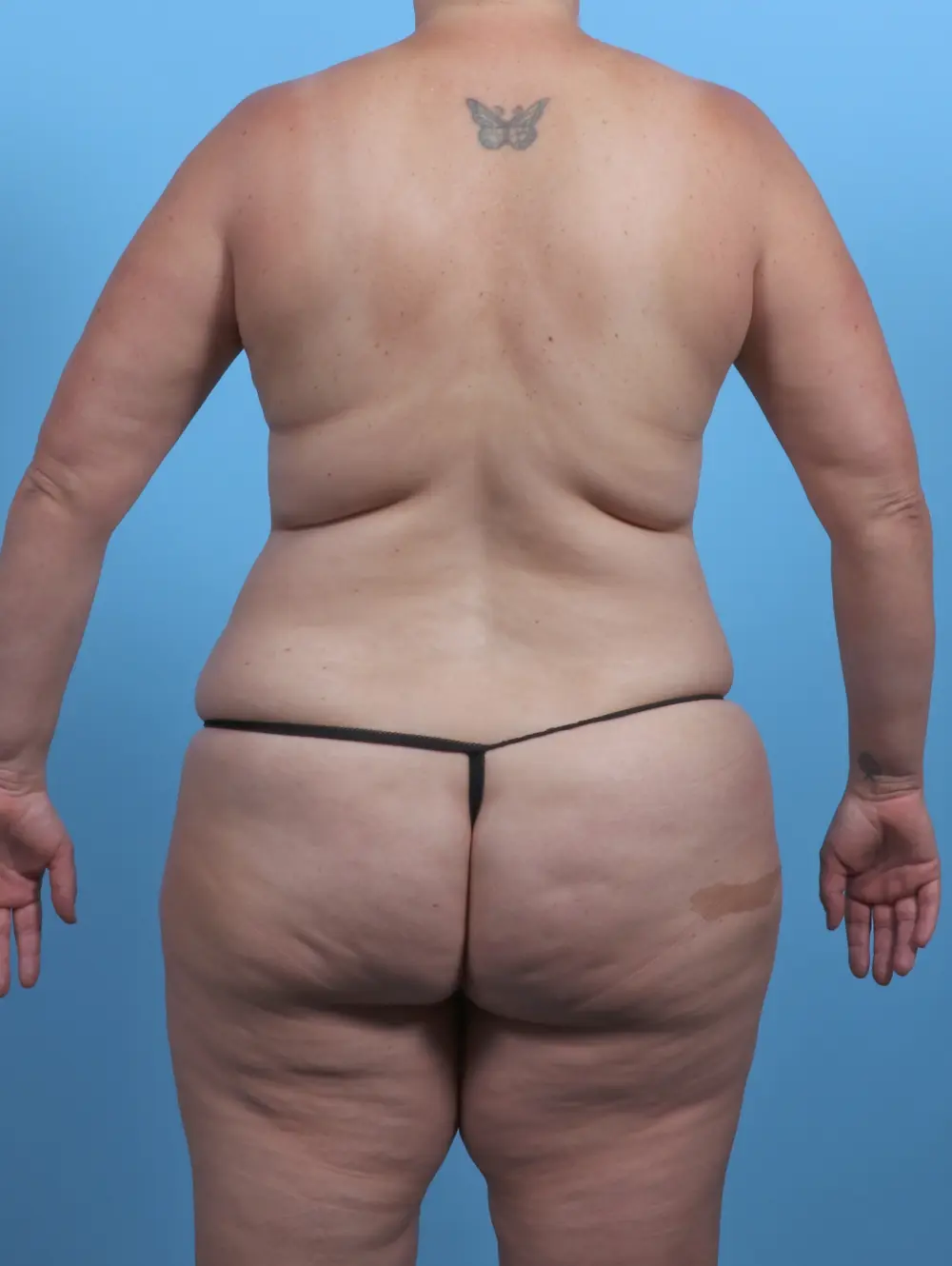 Breast Lift/Reduction with Implants Patient Photo - Case 45704 - before view-3