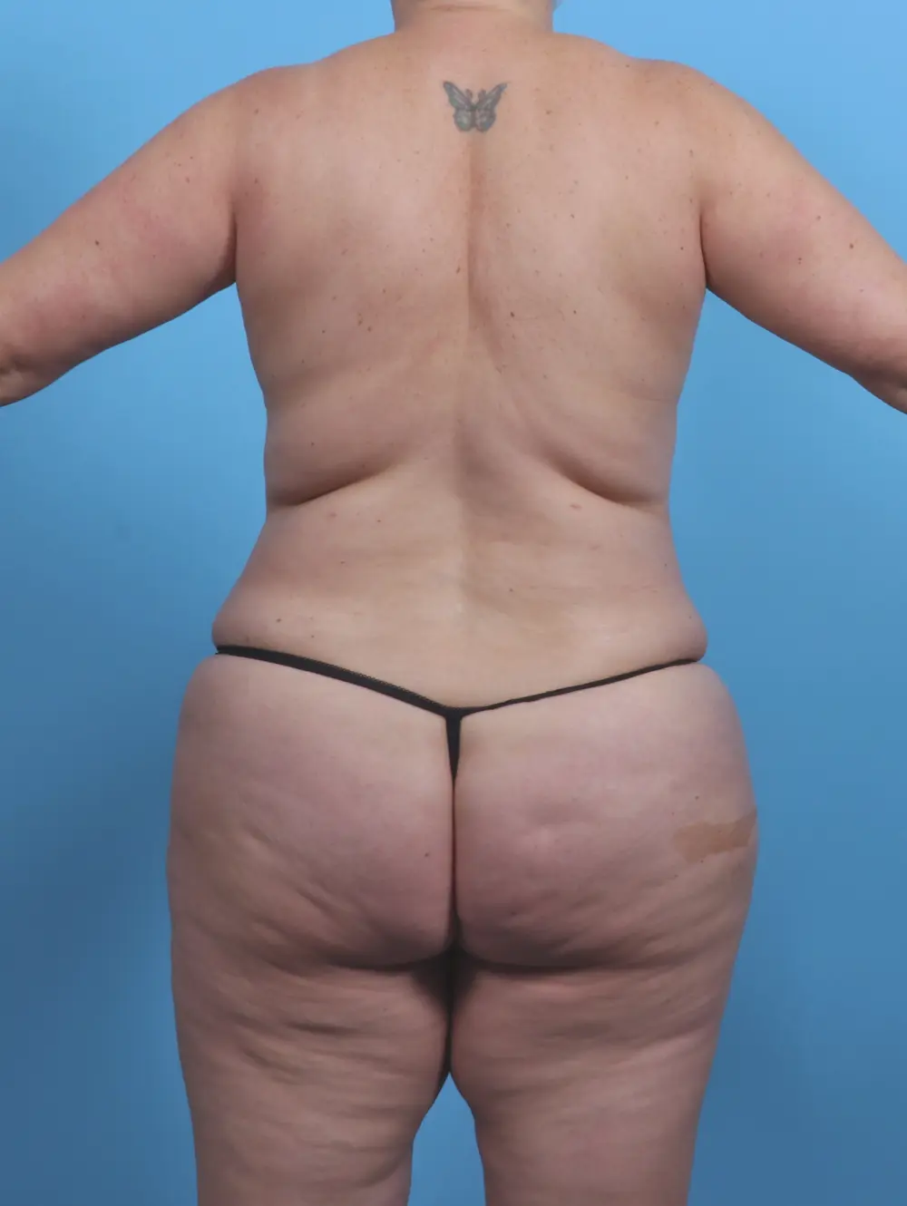 Breast Lift/Reduction with Implants Patient Photo - Case 45704 - after view-3