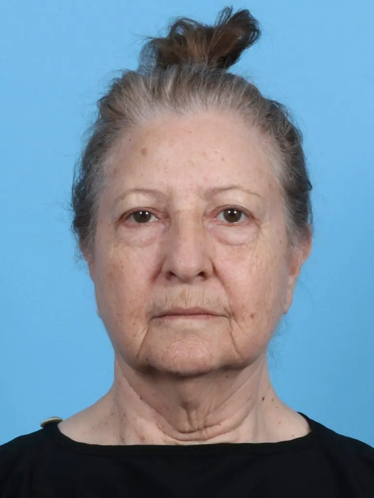 Eyelid Surgery - Case 45714 - Before