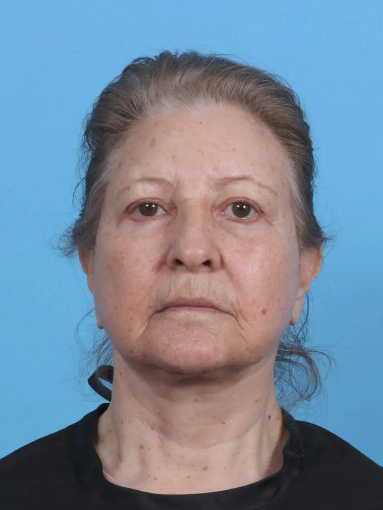 Eyelid Surgery - Case 45714 - After