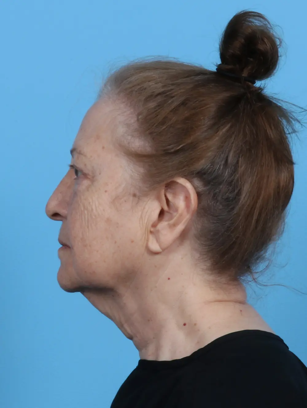 Eyelid Surgery Patient Photo - Case 45714 - before view-2