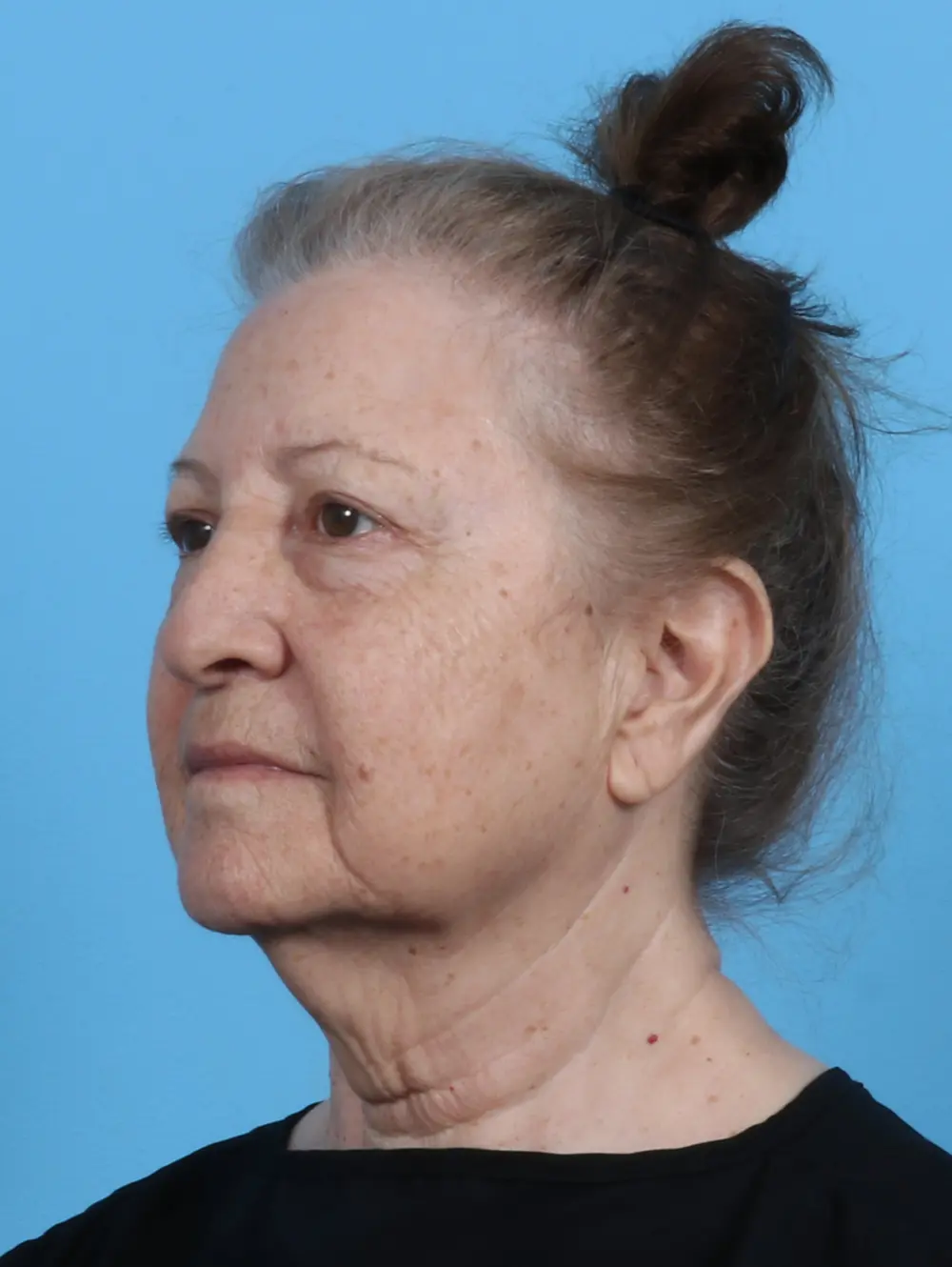Eyelid Surgery Patient Photo - Case 45714 - before view-1