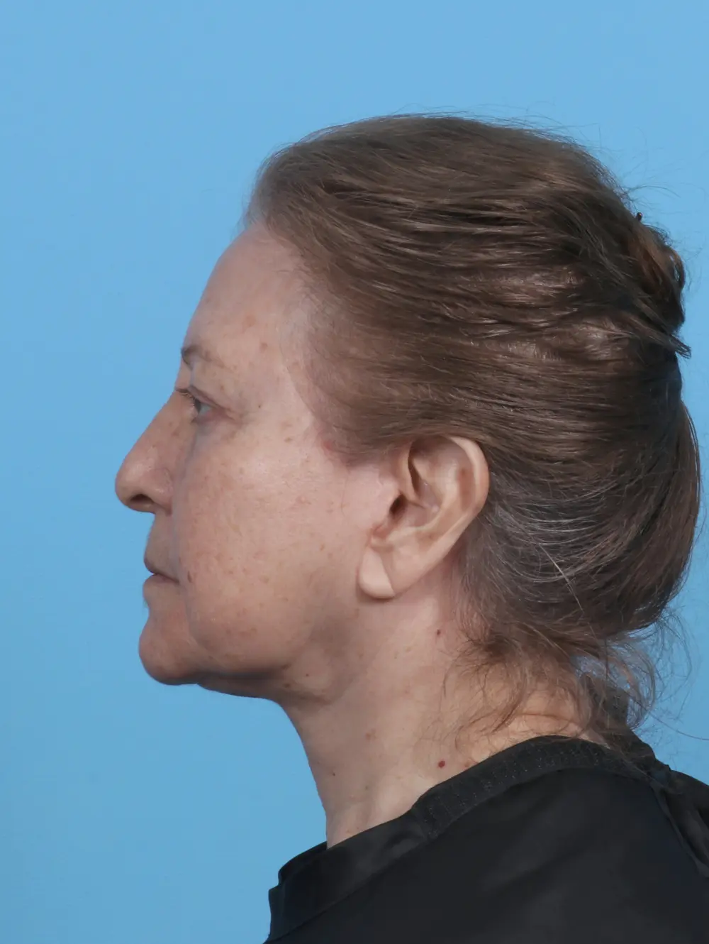 Eyelid Surgery Patient Photo - Case 45714 - after view-2