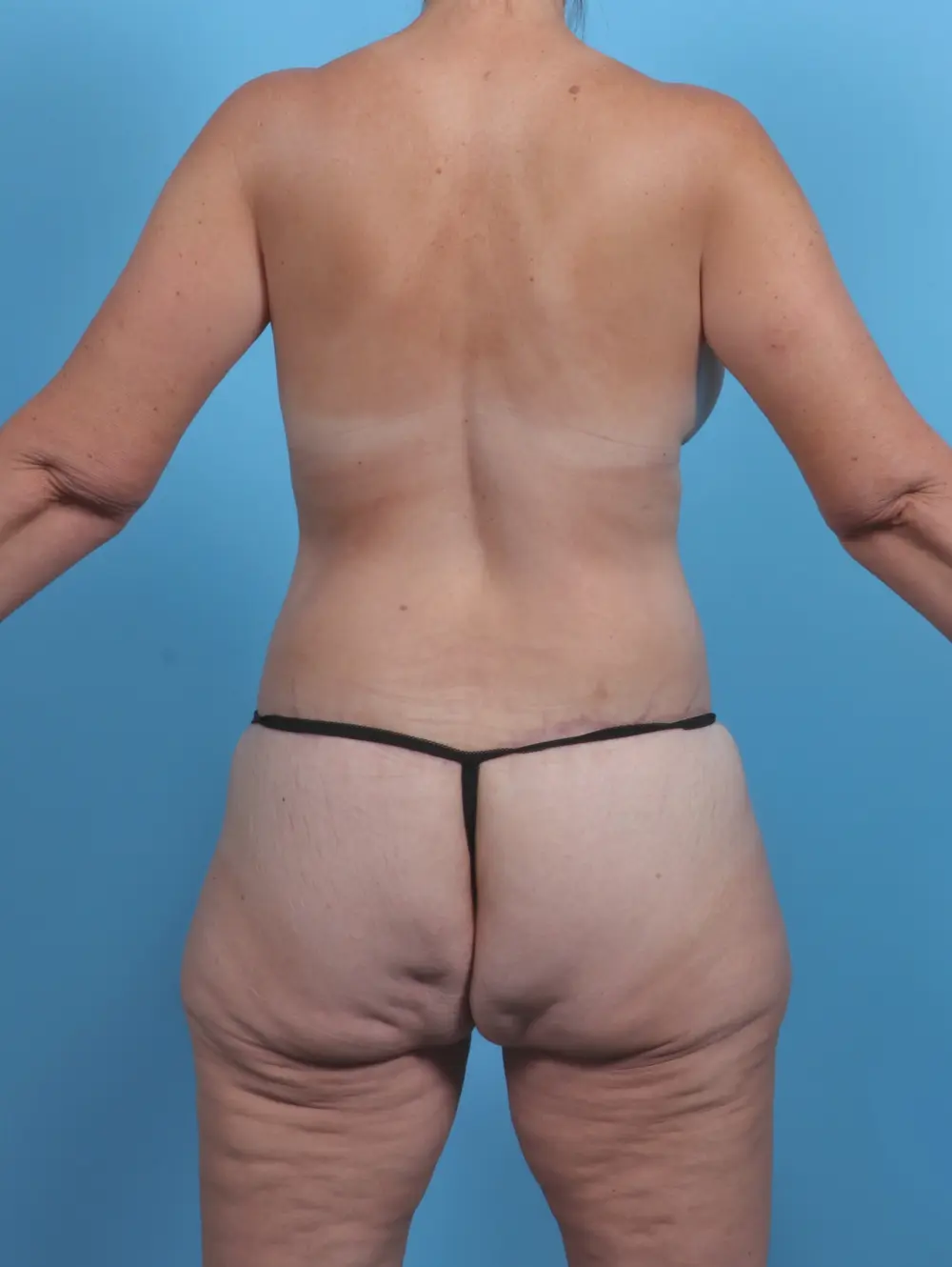 After Weight Loss Patient Photo - Case 45722 - after view-3