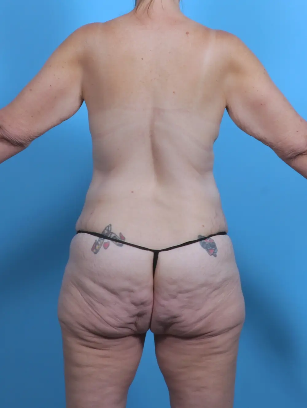 After Weight Loss Patient Photo - Case 45722 - before view-3