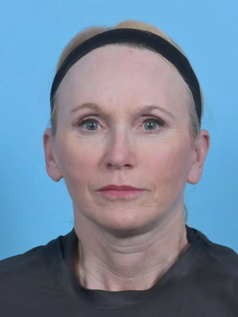 Facelift / Neck Lift - Case 45747 - After