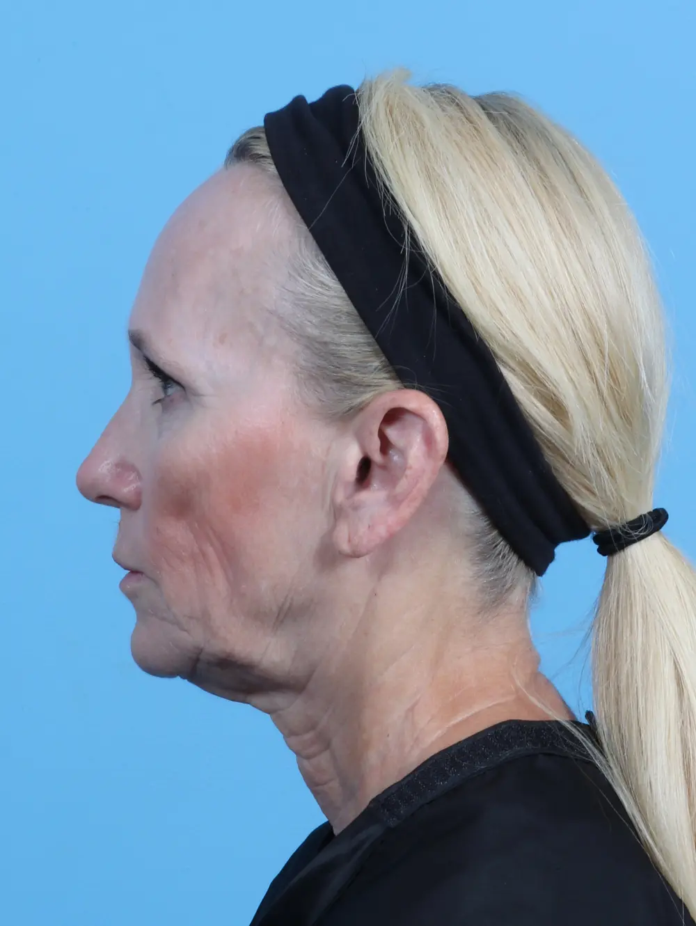 Facelift / Neck Lift Patient Photo - Case 45747 - before view-2
