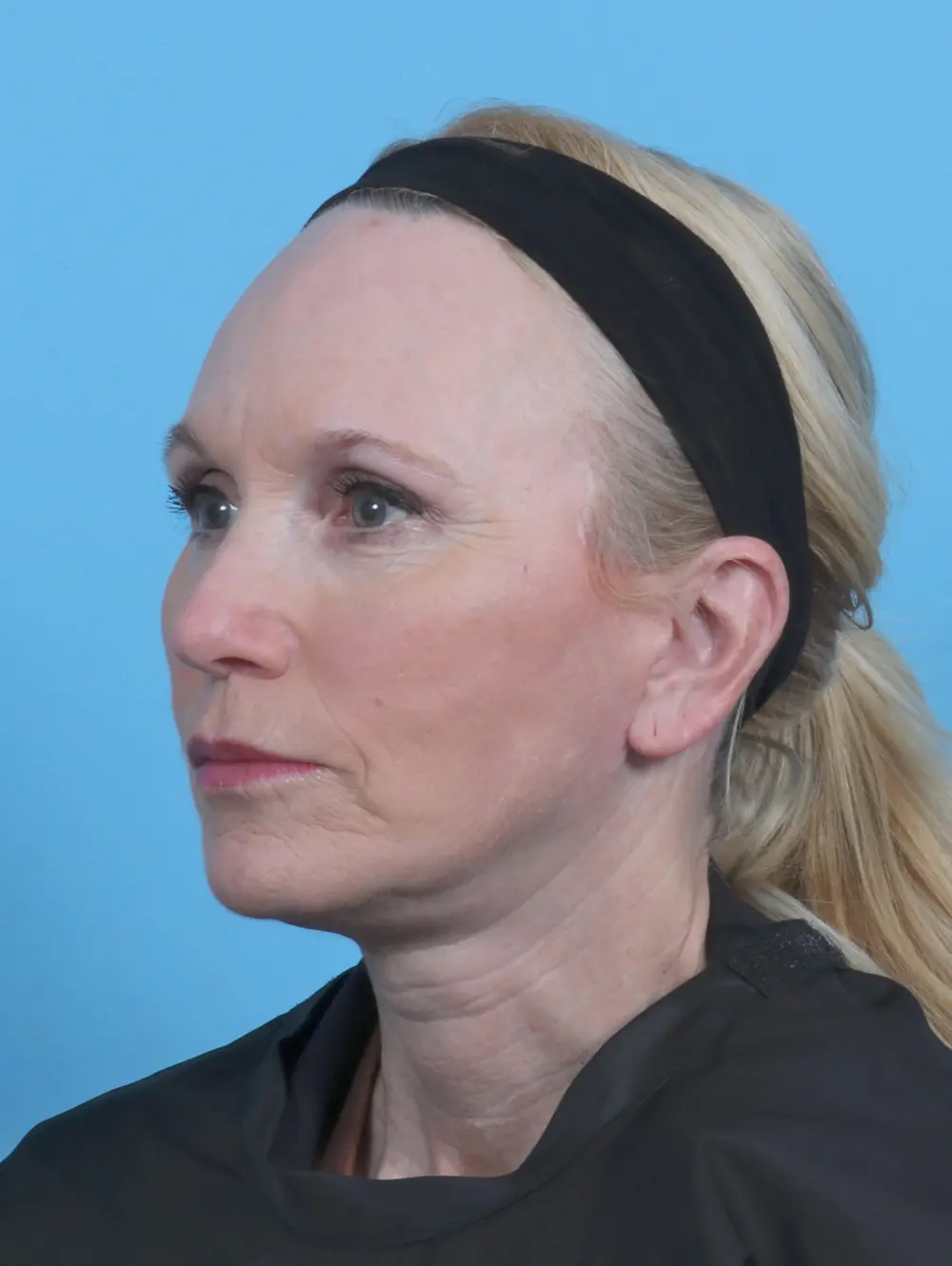 Facelift / Neck Lift Patient Photo - Case 45747 - after view-1
