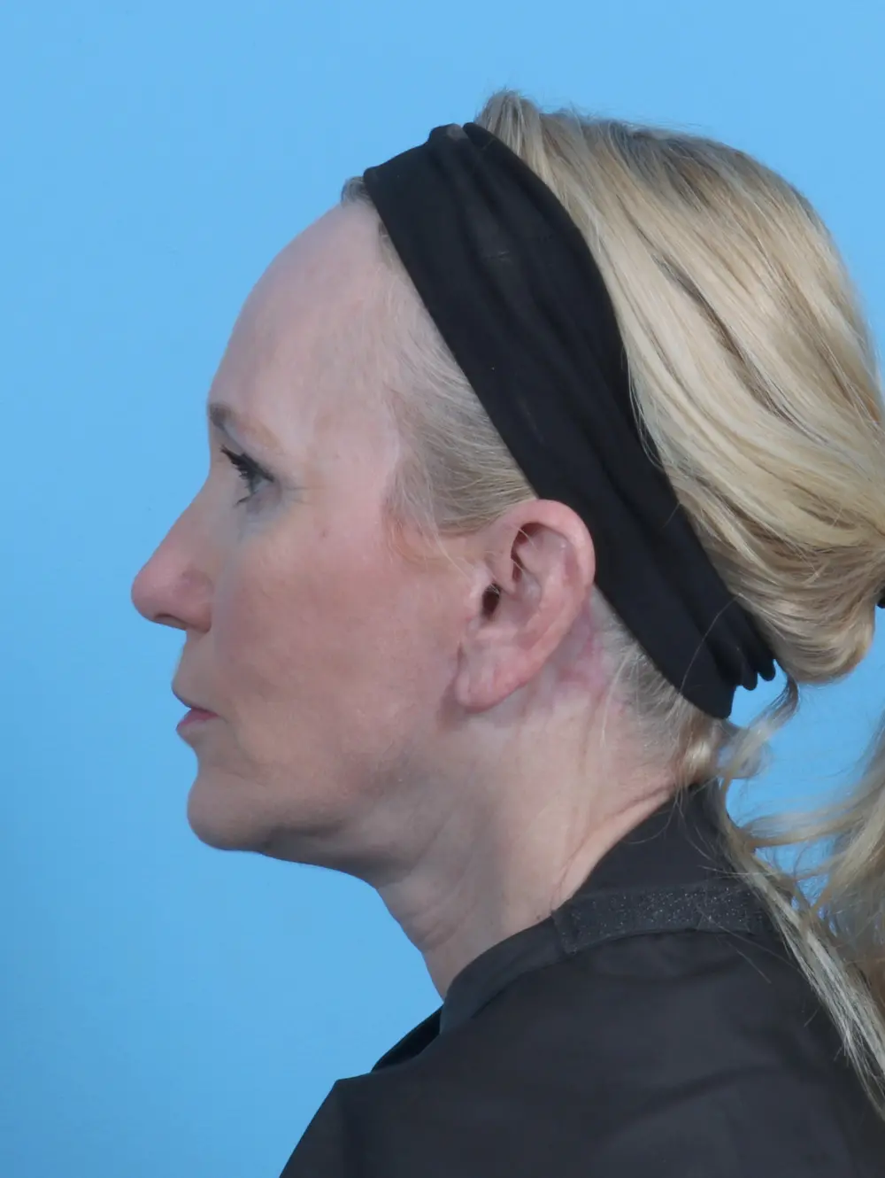 Facelift / Neck Lift Patient Photo - Case 45747 - after view-2