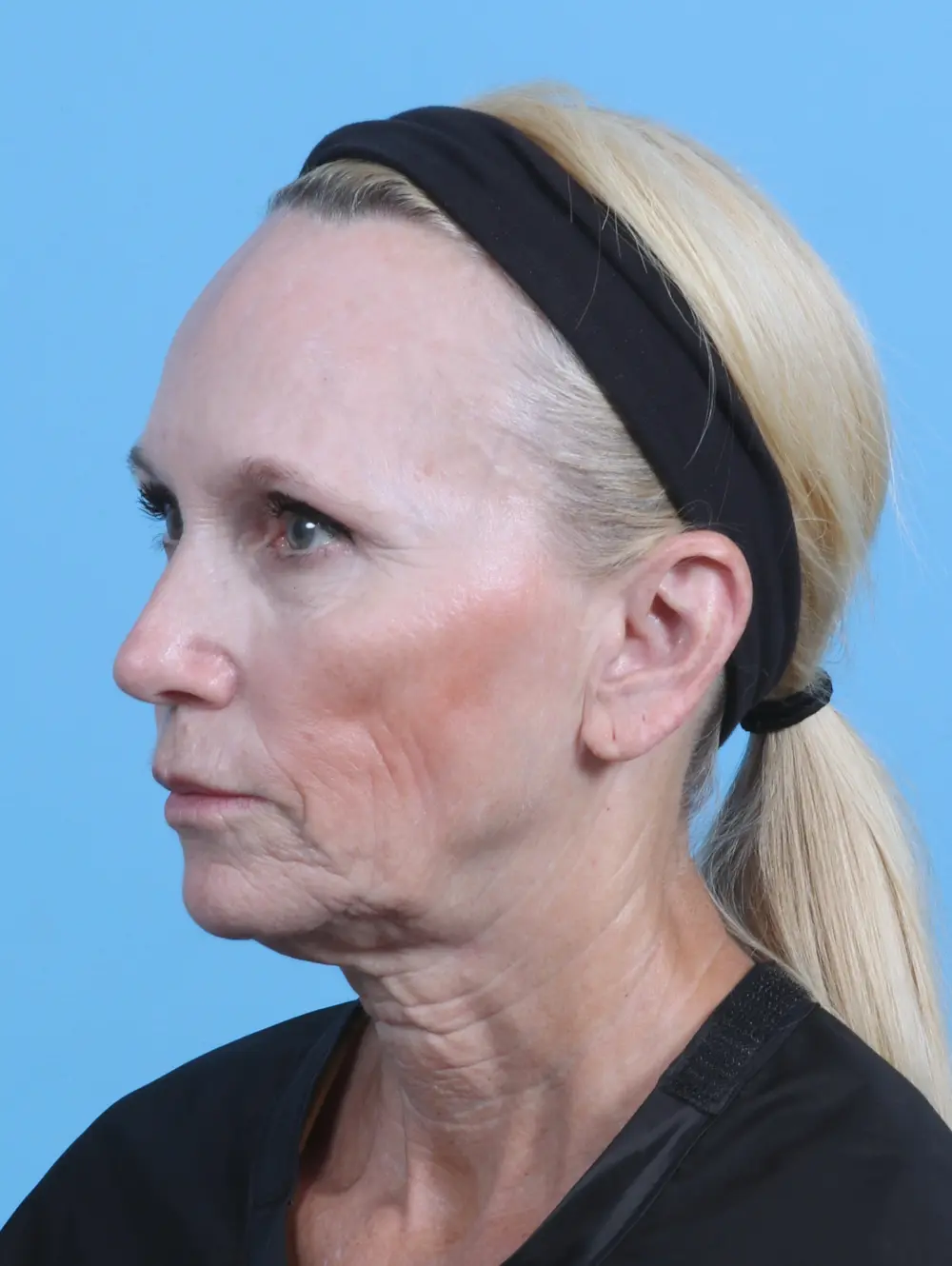 Facelift / Neck Lift Patient Photo - Case 45747 - before view-1