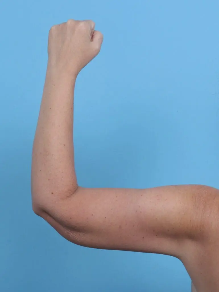 Arm Lift - Case 45777 - After