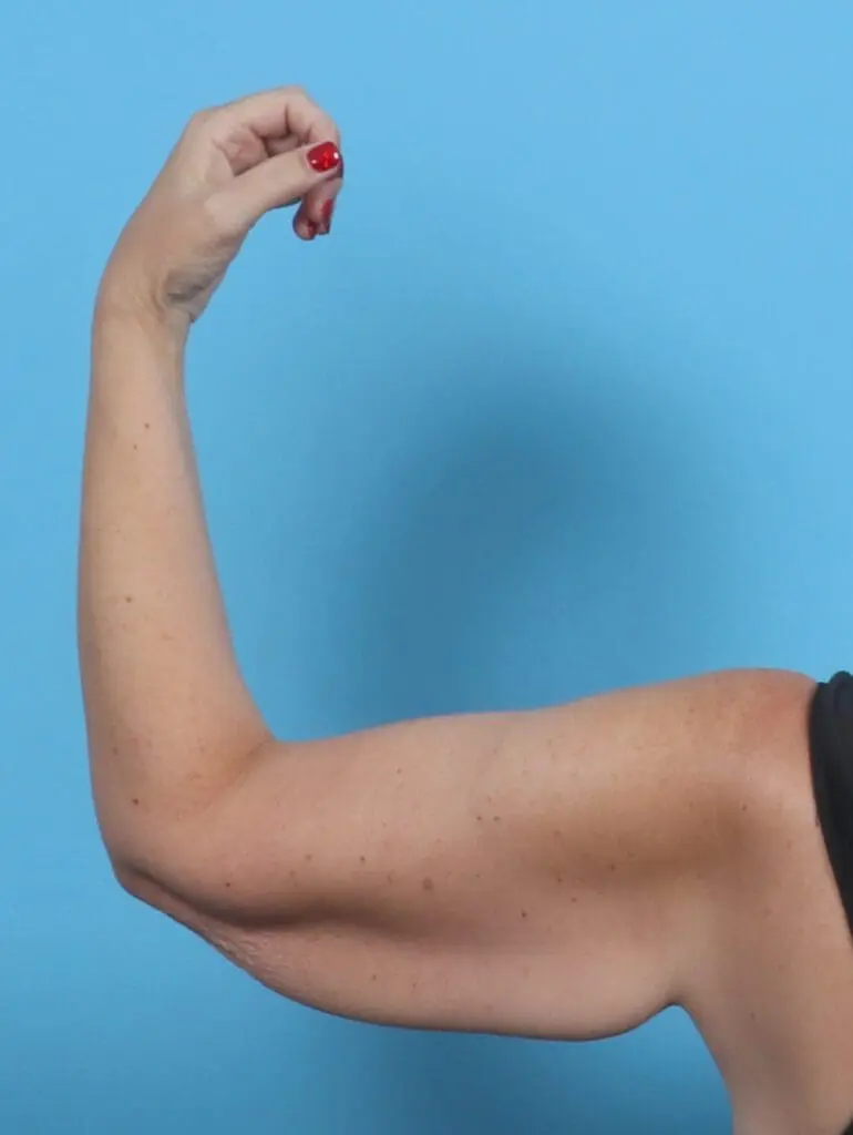 Arm Lift - Case 45777 - Before