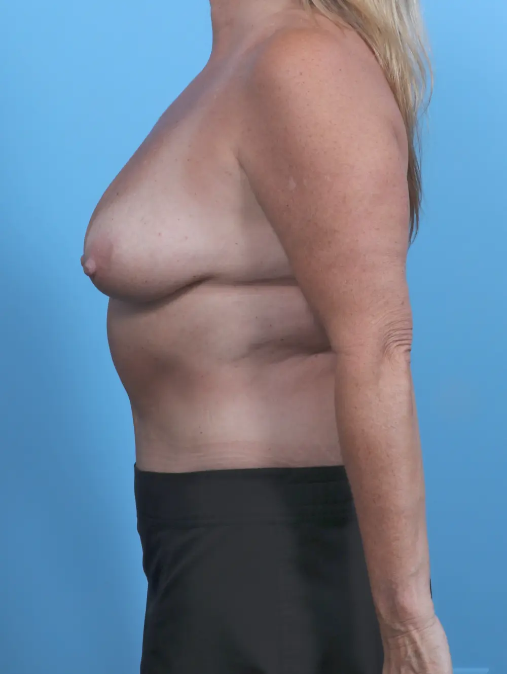 Breast Lift/Reduction w/o Implants Patient Photo - Case 45789 - before view-2